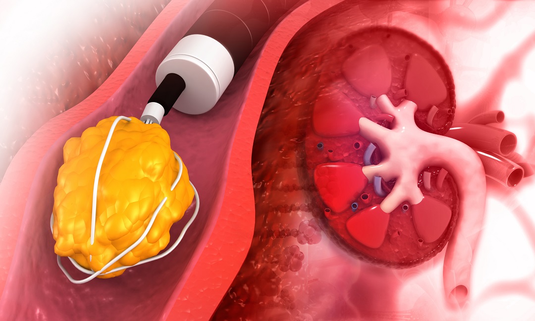 Cirurgia de Cálculo Renal